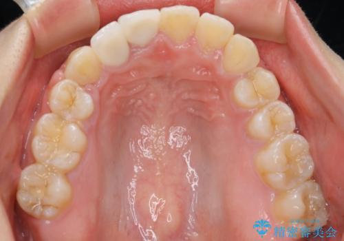 前歯の不自然なセラミック 下のすきっ歯 矯正治療で総合的に美しくの治療後