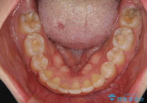 前歯の不自然なセラミック　下のすきっ歯　矯正治療で総合的に美しくの治療後