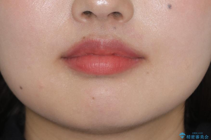 前歯の不自然なセラミック 下のすきっ歯 矯正治療で総合的に美しくの治療後(顔貌)