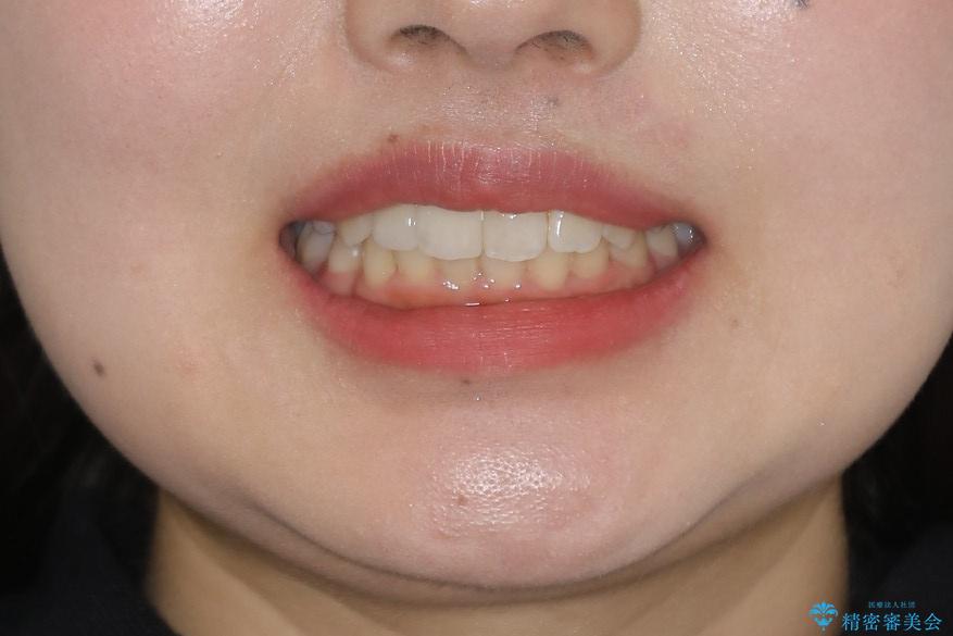 前歯の不自然なセラミック 下のすきっ歯 矯正治療で総合的に美しくの治療後(顔貌)