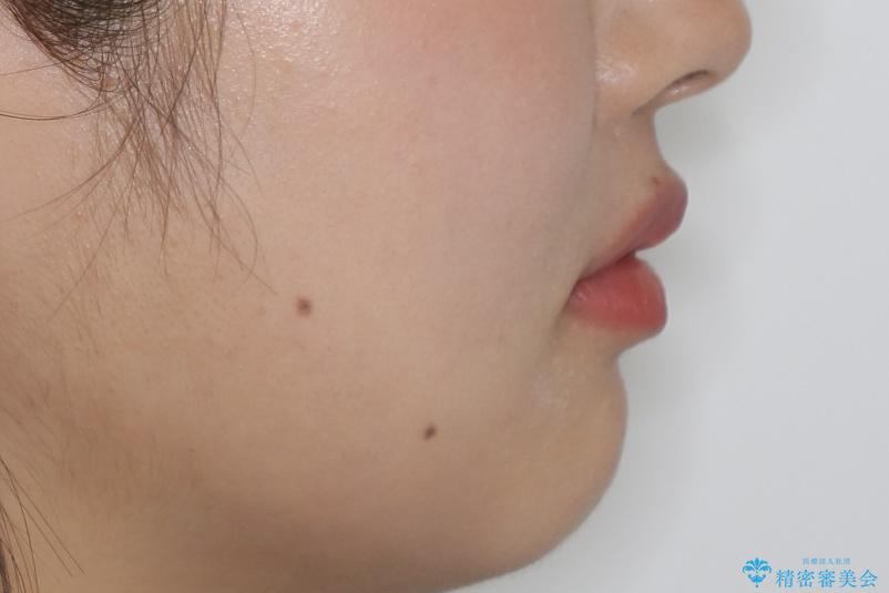 前歯の不自然なセラミック 下のすきっ歯 矯正治療で総合的に美しくの治療後(顔貌)