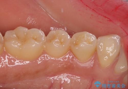 痛みでうずく 根管治療と補綴治療の治療前