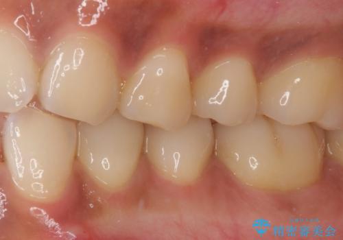 痛みでうずく 根管治療と補綴治療の治療前