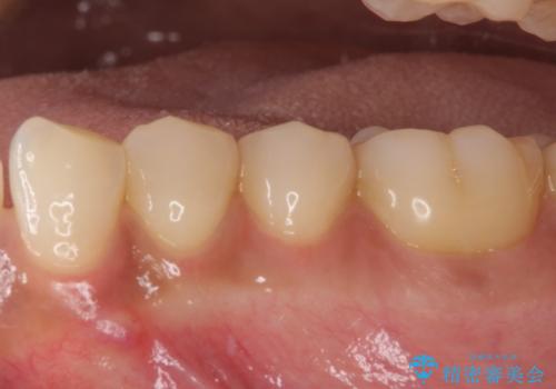痛みでうずく 根管治療と補綴治療の治療前