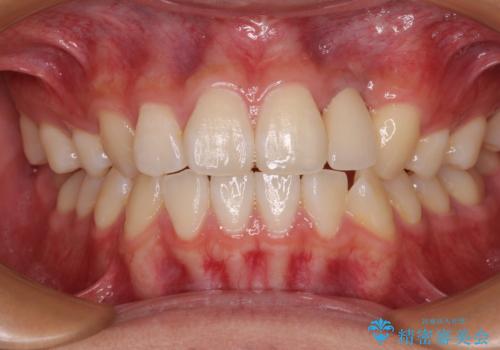 抜歯と言われた前歯 牽引してセラミッククラウンで保存するの治療後