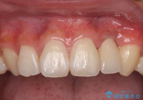 抜歯と言われた前歯 牽引してセラミッククラウンで保存する