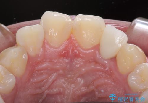 抜歯と言われた前歯 牽引してセラミッククラウンで保存するの治療後