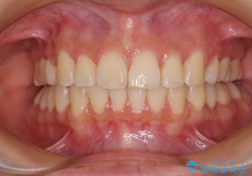 飛び出した前歯を引っ込めたい ワイヤー装置での抜歯矯正の症例 治療後