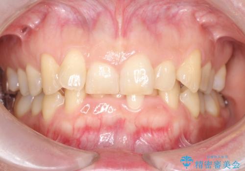 インビザライン矯正　前歯のガタツキが治り、綺麗なスマイルに!の症例 治療前