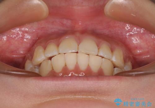 飛び出した前歯を引っ込めたい ワイヤー装置での抜歯矯正の治療後