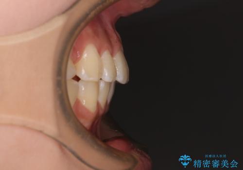 飛び出した前歯を引っ込めたい ワイヤー装置での抜歯矯正の治療後