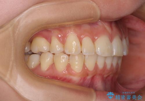 飛び出した前歯を引っ込めたい ワイヤー装置での抜歯矯正の治療後