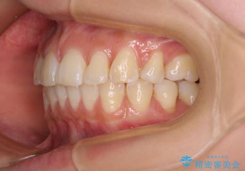 飛び出した前歯を引っ込めたい ワイヤー装置での抜歯矯正の治療後