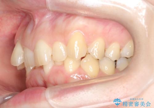 インビザライン矯正　前歯のガタツキが治り、綺麗なスマイルに!の治療前
