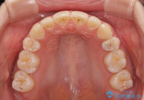 飛び出した前歯を引っ込めたい ワイヤー装置での抜歯矯正の治療後