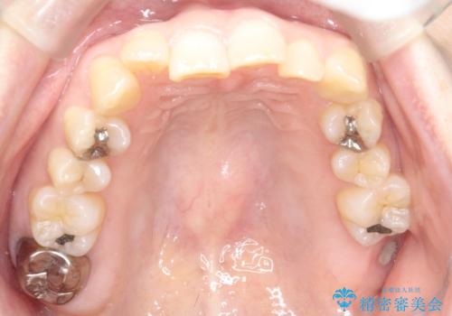 インビザライン矯正　前歯のガタツキが治り、綺麗なスマイルに!の治療前