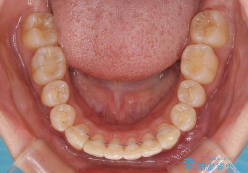 飛び出した前歯を引っ込めたい ワイヤー装置での抜歯矯正の治療後