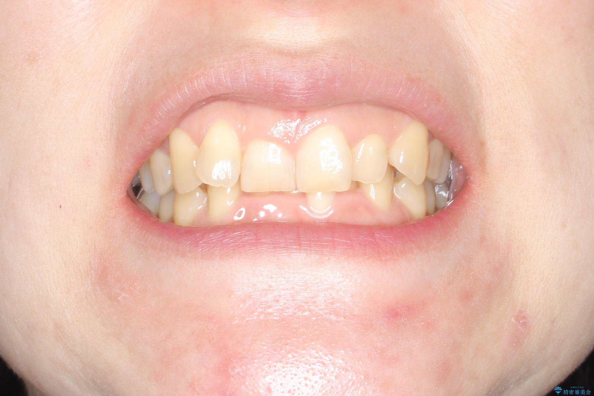 インビザライン矯正　前歯のガタツキが治り、綺麗なスマイルに!の治療前（顔貌）