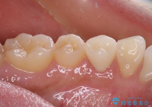 痛みでうずく 根管治療と補綴治療の治療後