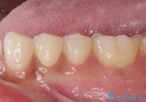 痛みでうずく 根管治療と補綴治療の治療後