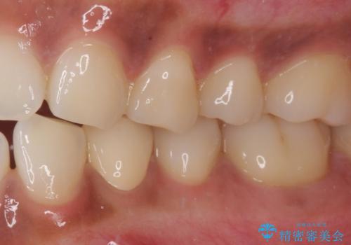 痛みでうずく 根管治療と補綴治療の治療後