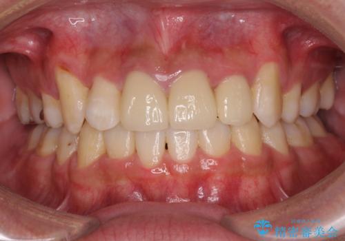 デコボコと変色した前歯　抜歯矯正と審美歯科治療の症例 治療後