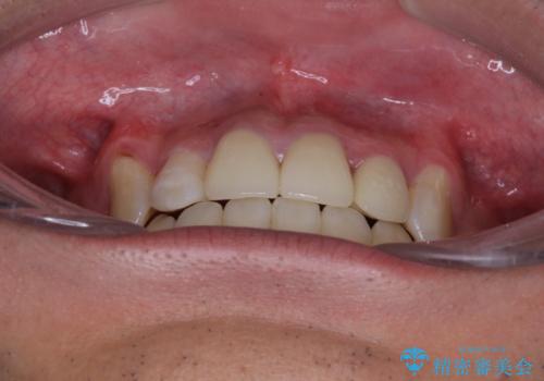 デコボコと変色した前歯 抜歯矯正と審美歯科治療の治療後