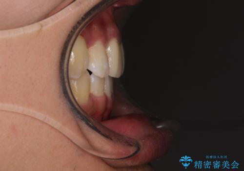 デコボコと変色した前歯 抜歯矯正と審美歯科治療の治療後