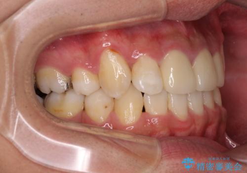 デコボコと変色した前歯 抜歯矯正と審美歯科治療の治療後