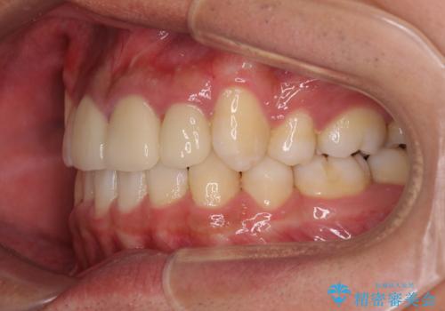 デコボコと変色した前歯　抜歯矯正と審美歯科治療の治療後