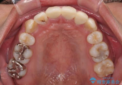 デコボコと変色した前歯 抜歯矯正と審美歯科治療の治療後