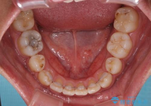 デコボコと変色した前歯 抜歯矯正と審美歯科治療の治療後