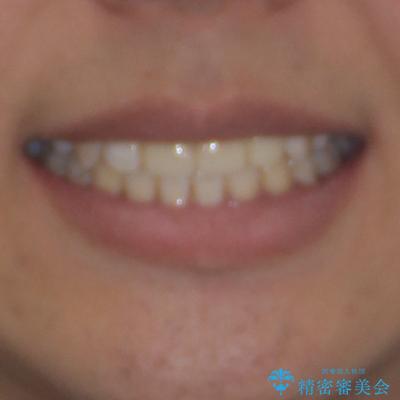 デコボコと変色した前歯　抜歯矯正と審美歯科治療の治療後（顔貌）