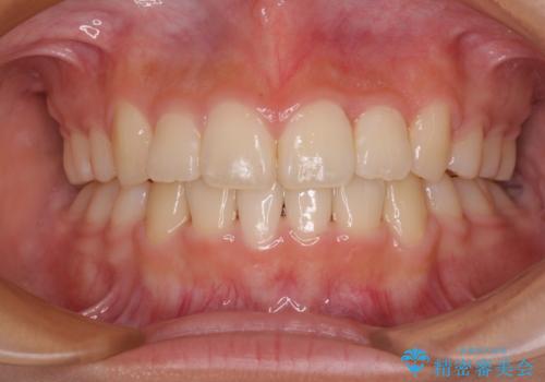 上顎骨幅が狭い 急速拡大装置を併用した抜歯矯正の症例 治療後