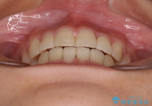 上顎骨幅が狭い 急速拡大装置を併用した抜歯矯正の治療後