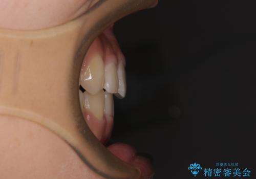 上顎骨幅が狭い　急速拡大装置を併用した抜歯矯正の治療後