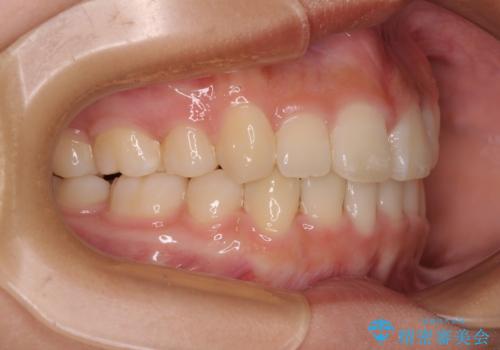 上顎骨幅が狭い 急速拡大装置を併用した抜歯矯正の治療後