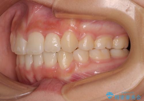 上顎骨幅が狭い 急速拡大装置を併用した抜歯矯正の治療後