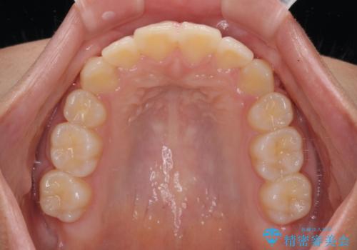 上顎骨幅が狭い 急速拡大装置を併用した抜歯矯正の治療後