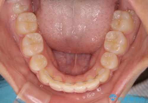 上顎骨幅が狭い 急速拡大装置を併用した抜歯矯正の治療後