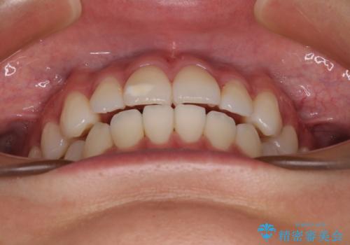 咬み合わせの乱れを改善 ワイヤー装置で楽々矯正治療の治療後