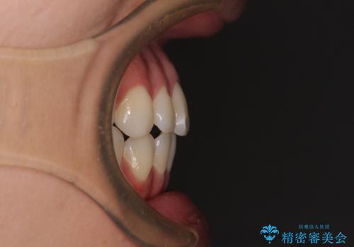 咬み合わせの乱れを改善 ワイヤー装置で楽々矯正治療の治療後