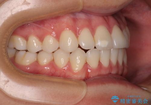 咬み合わせの乱れを改善 ワイヤー装置で楽々矯正治療の治療後