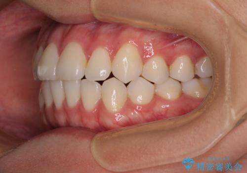 咬み合わせの乱れを改善 ワイヤー装置で楽々矯正治療の治療後