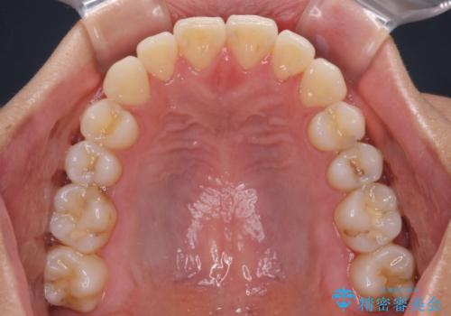 咬み合わせの乱れを改善 ワイヤー装置で楽々矯正治療の治療後