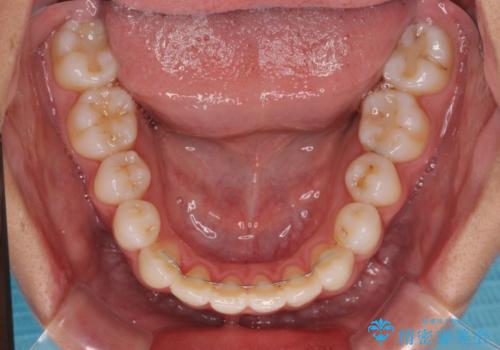 咬み合わせの乱れを改善 ワイヤー装置で楽々矯正治療の治療後