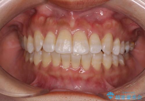 気になる八重歯 ワイヤー装置での非抜歯矯正の症例 治療後