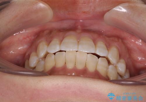 気になる八重歯 ワイヤー装置での非抜歯矯正の治療後