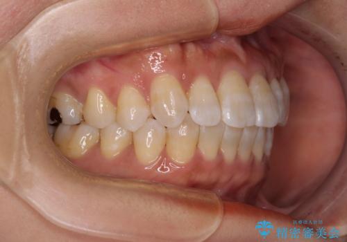 気になる八重歯 ワイヤー装置での非抜歯矯正の治療後