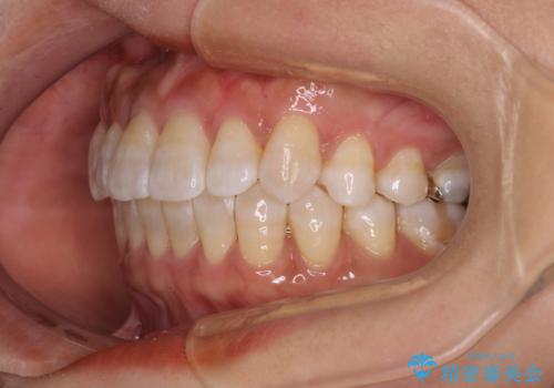 気になる八重歯　ワイヤー装置での非抜歯矯正の治療後